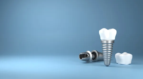 implants-right-dr-sebastian-fotescu-zahnarztpraxis-dresden-webp