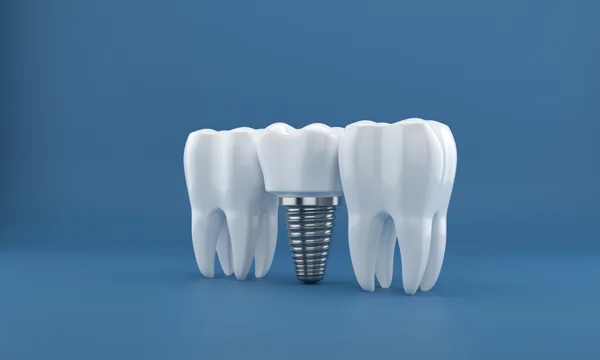 tooth-bridge-dr-sebastian-fotescu-zahnarztpraxis-dresden-webp